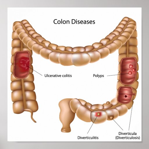 Colon pathologies Poster | Zazzle