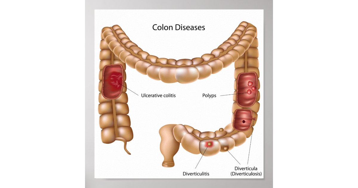 Patho Colon Colon pathologies Poster | Zazzle