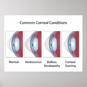 Common corneal conditions Poster