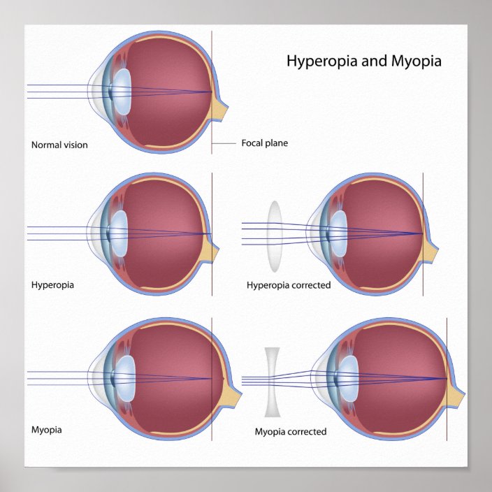 Common Eye defects Poster | Zazzle.com