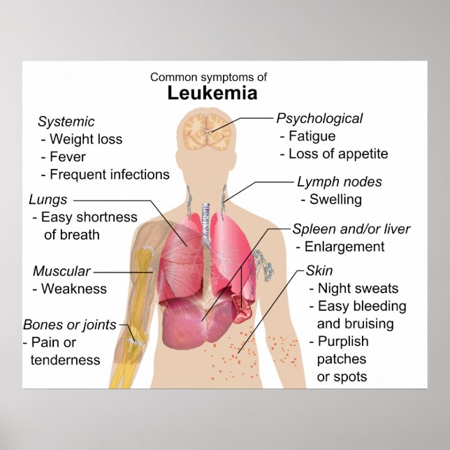 Common Symptoms Chart of Leukemia Blood Cancer (Front)