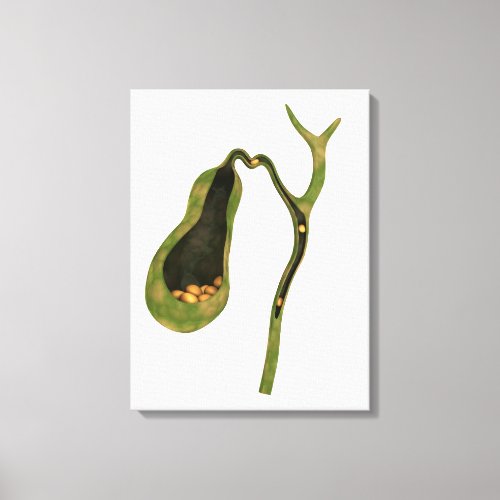 Conceptual Image Of Gallstones Inside Gall Canvas Print