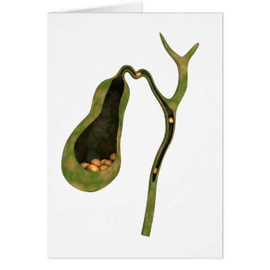 Conceptual Image Of Gallstones Inside Gall Cards (Front)