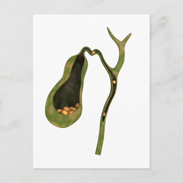 Conceptual Image Of Gallstones Inside Gall Postcard (Front)