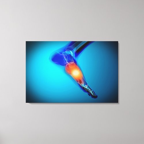 Conceptual Image Of Pain In Human Foot Canvas Print