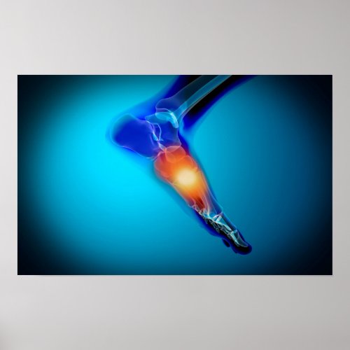 Conceptual Image Of Pain In Human Foot Poster