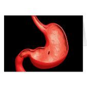 Conceptual Image Of Peptic Ulcer In Stomach (Front Horizontal)