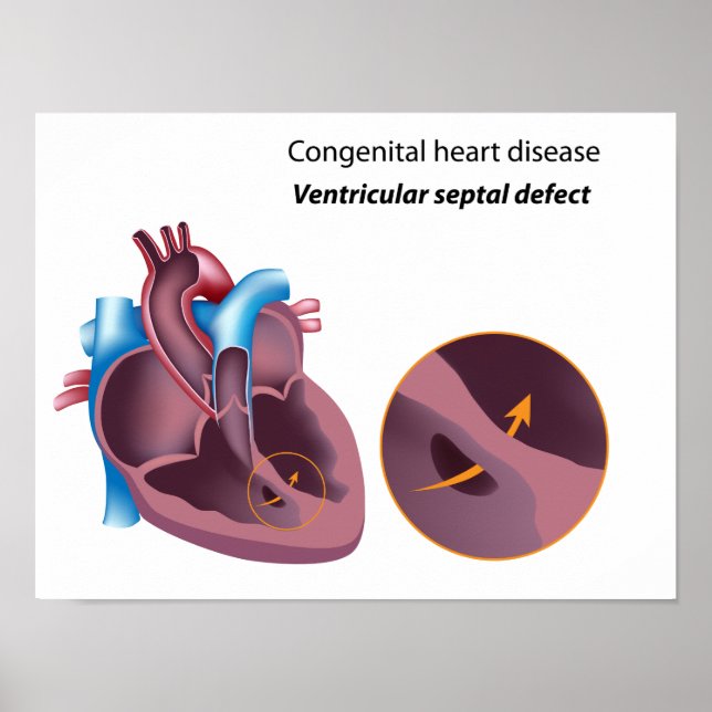 Congenital heart disease  Poster (Front)