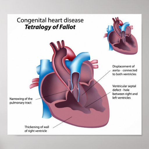 Congenital heart disease Poster | Zazzle