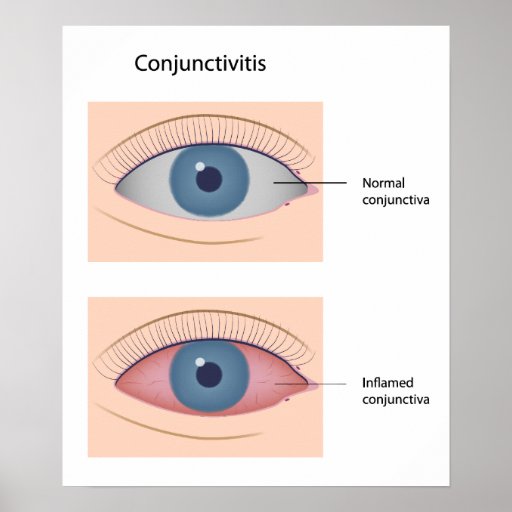 Conjunctivitis eye disease Poster | Zazzle