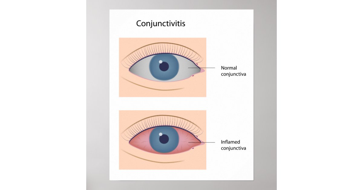 Conjunctivitis eye disease Poster | Zazzle