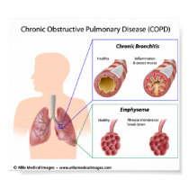 COPD Lung diseases diagram Poster