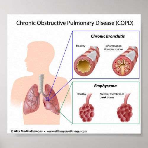 COPD Lung diseases diagram Poster