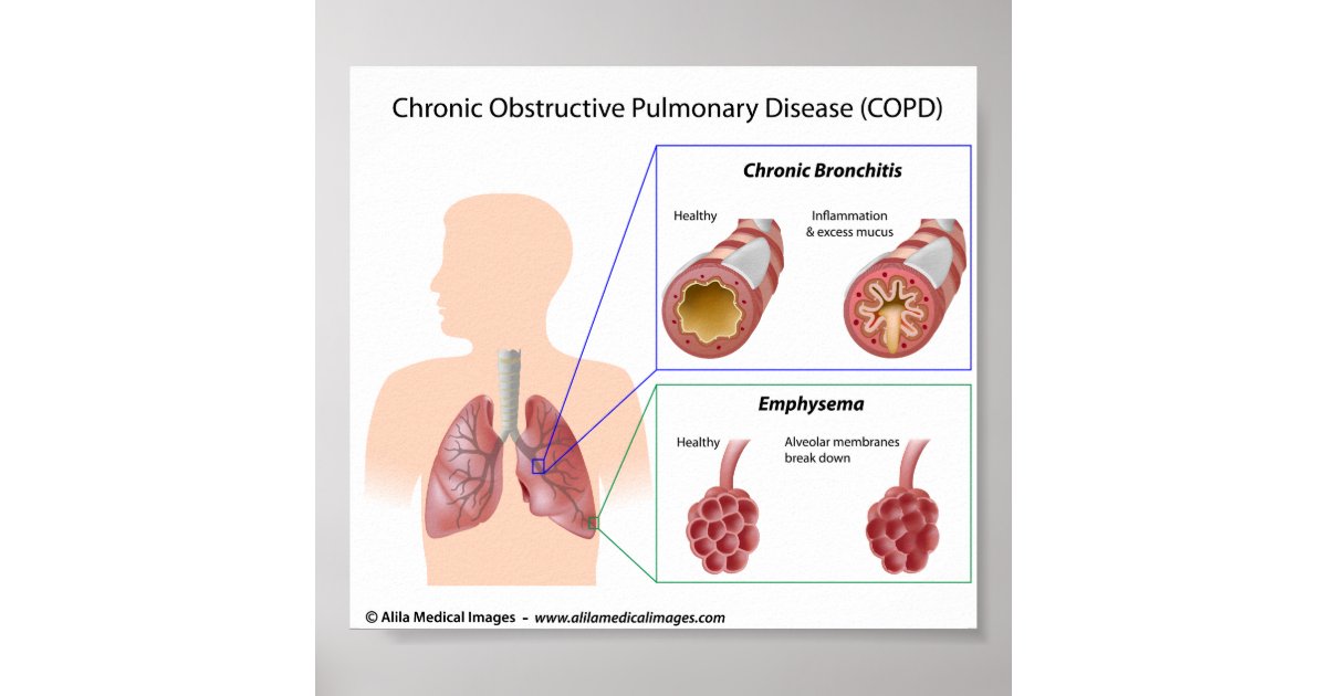 iphone buttons diagram 5 of Poster  Lung Zazzle.com  COPD diagram diseases