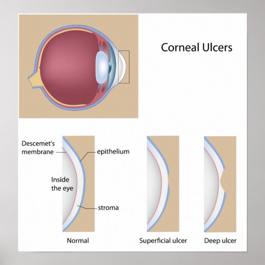 Corneal ulcer treatment guidelines picture