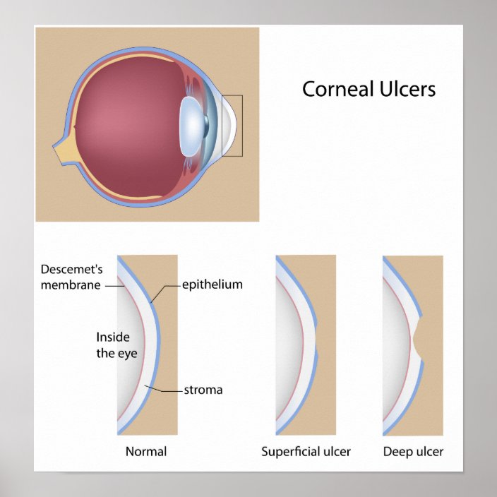 Corneal ulcer eye condition Poster | Zazzle.com