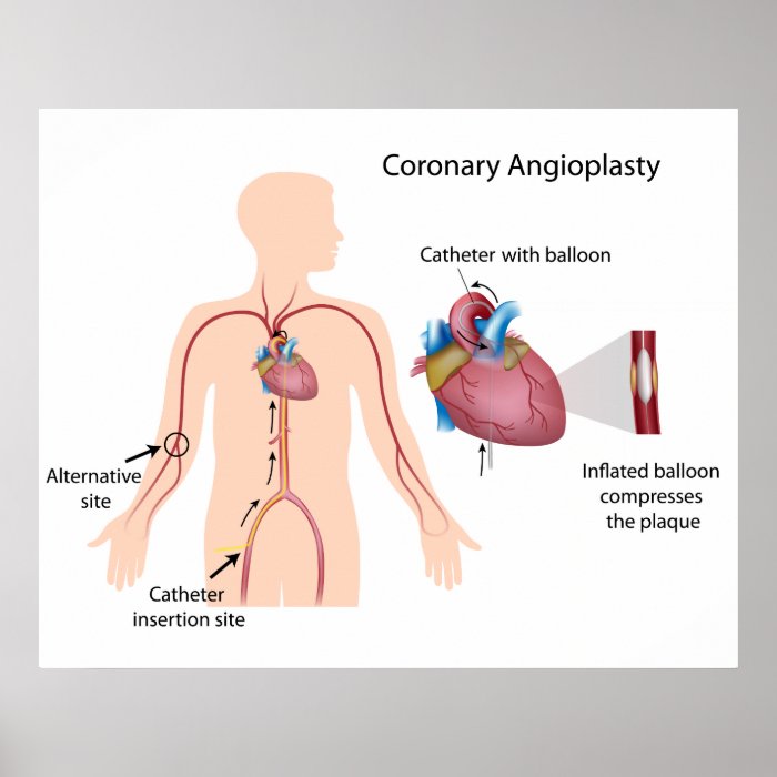 Coronary angioplasty Poster