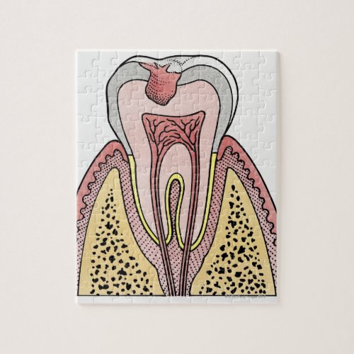 Cross section illustration showing tooth decay jigsaw puzzle