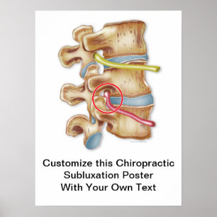 Customize Chiropractic Subluxation Poster