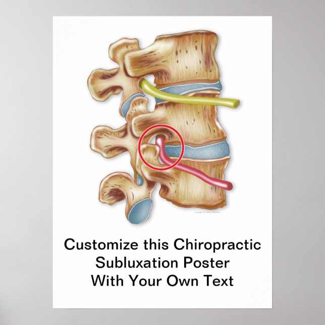Customize Chiropractic Subluxation Poster (Front)
