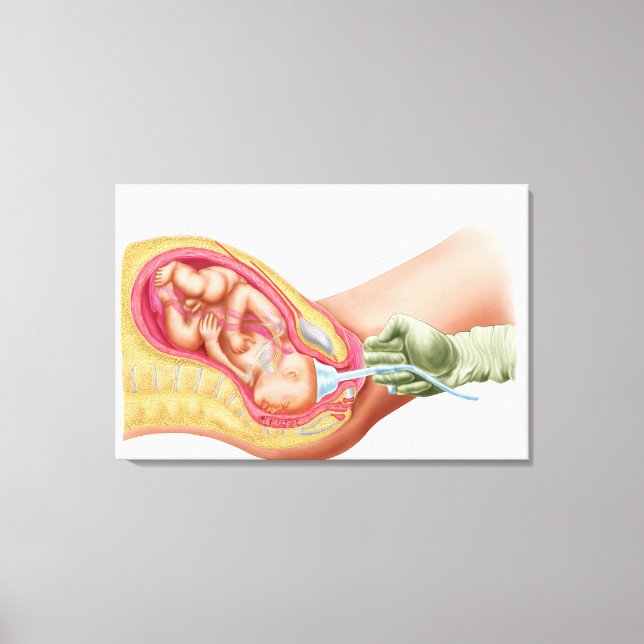 Delivery Of Fetus Using Vacuum Extraction Canvas Print (Front)