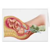 Delivery Of Fetus Using Vacuum Extraction Cards (Front Horizontal)