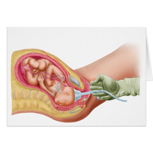 Delivery Of Fetus Using Vacuum Extraction Cards (Front Horizontal)
