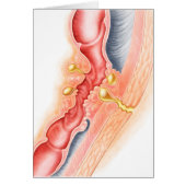 Development Of Fistula (Front)