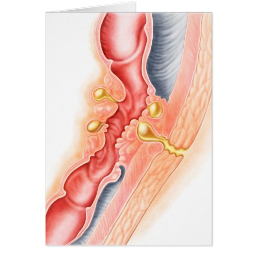 Development Of Fistula Cards (Front)