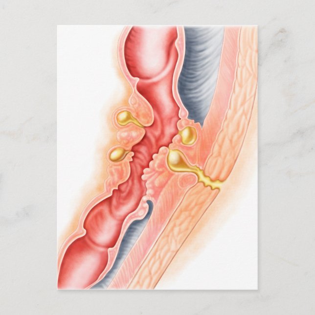 Development Of Fistula Postcard (Front)