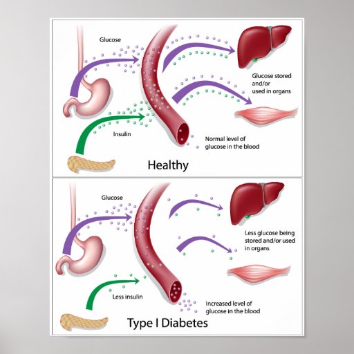 Diabetes type 1 Poster | Zazzle