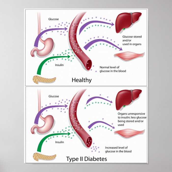 Diabetes type 2 print