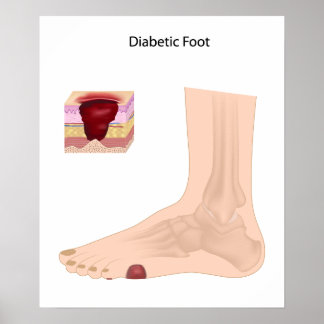 Diabetic Foot  Poster
