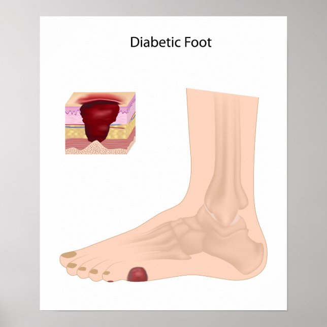 Diabetic Foot  Poster (Front)