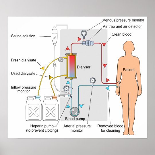 Diagram Of A Haemodialysis Medical Treatment Poster