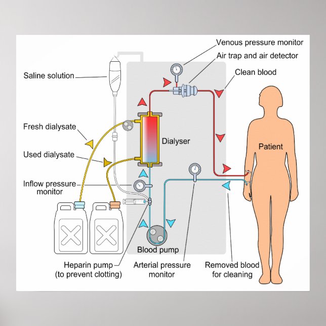 Diagram of a Haemodialysis Medical Treatment Poster (Front)