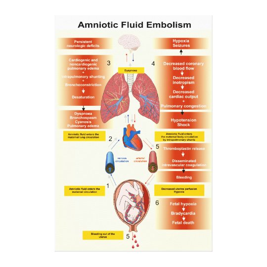 amniotic fluid embolism pdf