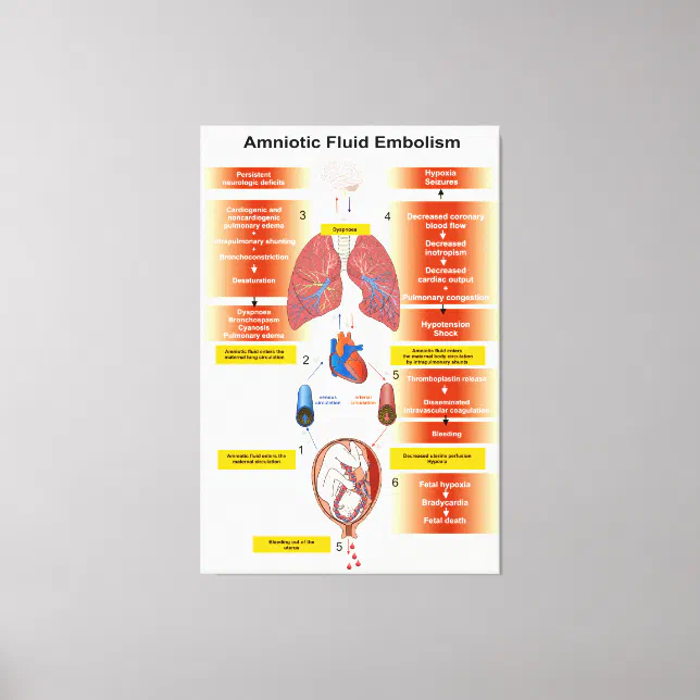 Diagram of an Amniotic Fluid Embolism AFE Canvas Print | Zazzle