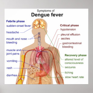 Diagram of the Main Symptoms of Dengue Fever Poster