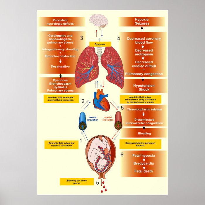 Diagrama de una embolia del líquido amniótico posters de