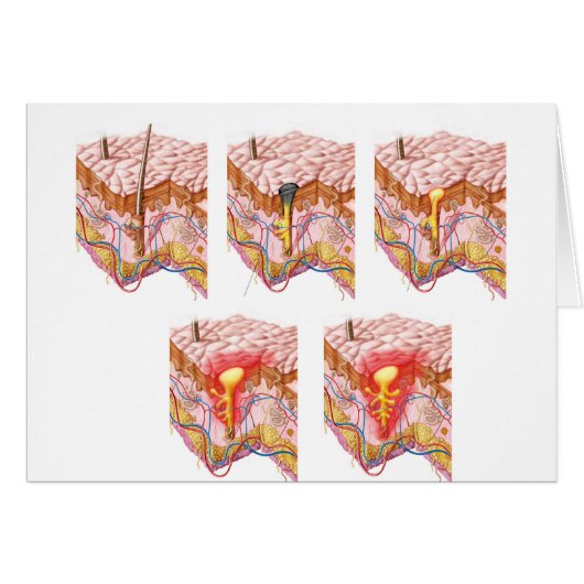 Different Types Of Acne Cards (Front Horizontal)