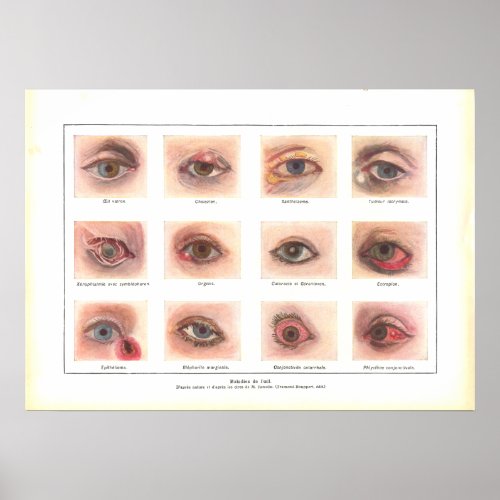 Diseases of Eye Anatomy Poster French