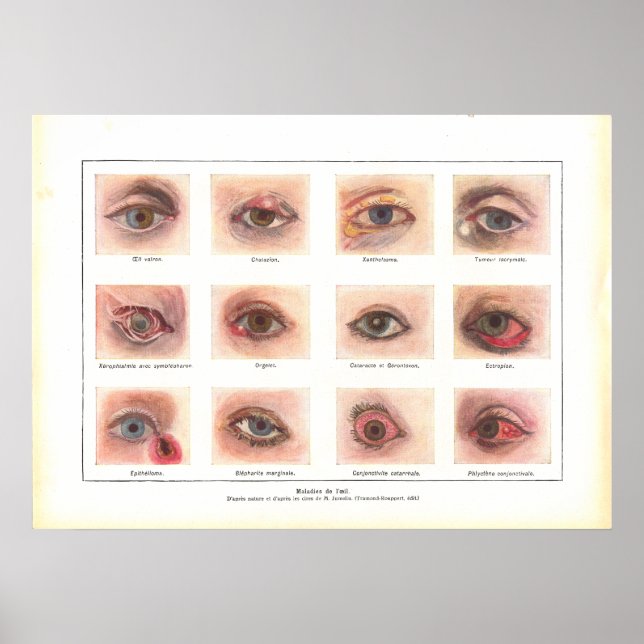 Diseases of Eye Anatomy Poster French (Front)