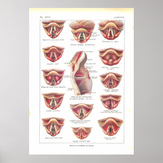 Diseases of Larynx Anatomy Poster French
