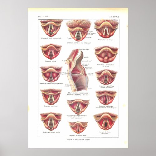Diseases of Larynx Anatomy Poster French
