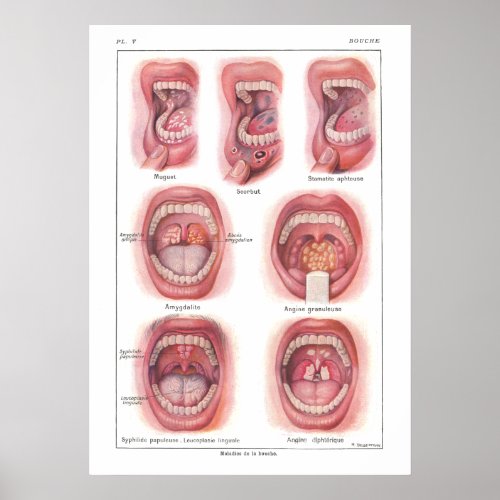 Diseases of Mouth Anatomy Poster French