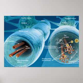 Disintegration of microtubules in a neuron poster