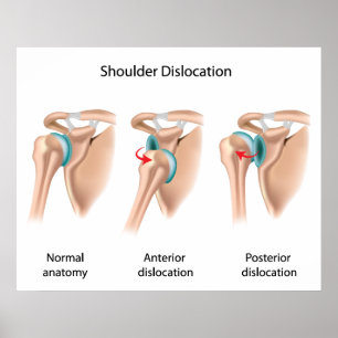 Dislocated shoulder Poster