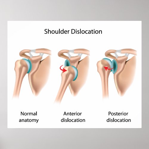 Dislocated shoulder Poster