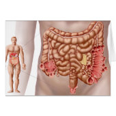 Diverticulitis In The Descending Colon Region (Front Horizontal)